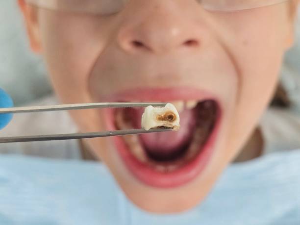 Best Emergency Treatment for Dental Infections or Abscesses in Hilbert, WI